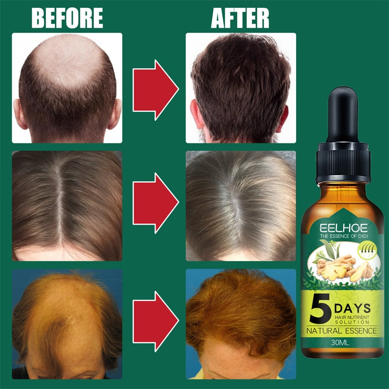 5 Days Ginger Hair Growth Products Natural Anti Hair Loss Prevent Baldness Treatment Fast Growing Nourish Dry Damaged Hair Care - Amazhona 