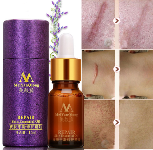 Scar Skin Repair Essential Oil Lavender Essence Care Natural Skin Pure Remove Ance Burn Strentch Marks Removal Scar 10 ML - Amazhona 