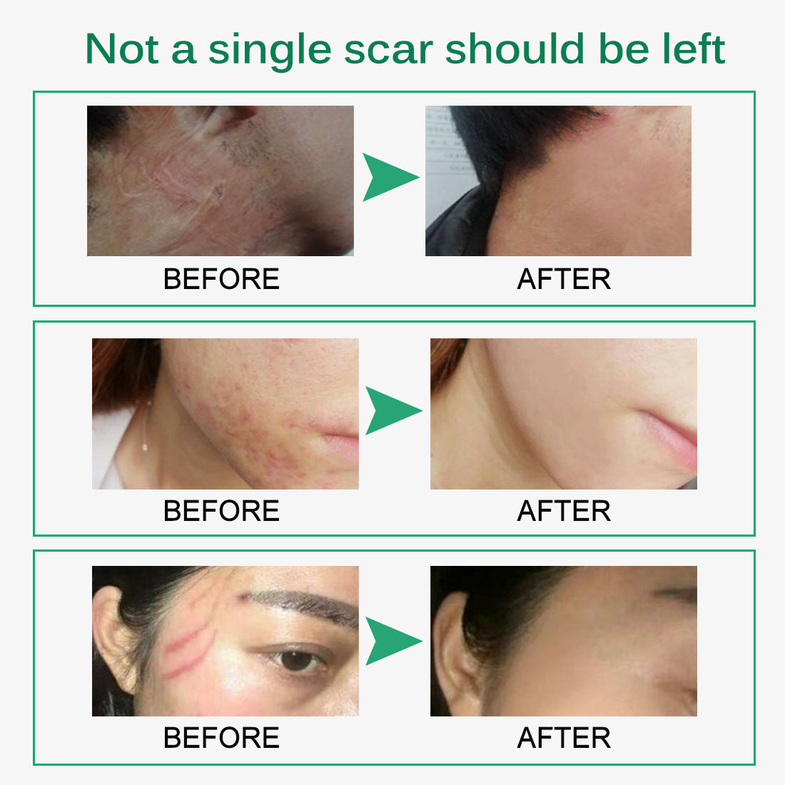 Skin Rebound Scarless Cream Scar Removal Cream Face Cream For Face Acne Scar Stretch Marks Skin Repair Face Cream - Amazhona 