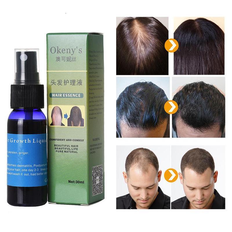 Sunburst Hair Growth Products for women&men anti hair loss products Alopecia Baldness beard oil growth Hair growth spray - Amazhona 